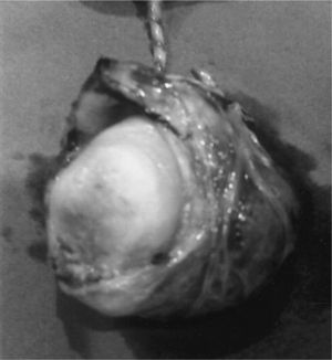Placenta insertada en cuerno uterino.