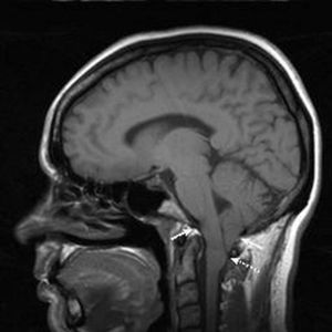 Imagen de RMN. Corte parasagital. Se observa el descenso de la amígdala cerebelosa (flecha discontinua) por debajo del agujero magno (flechas continuas).