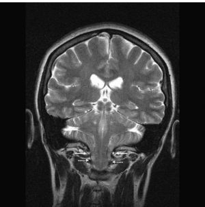 Imagen de RMN. Corte coronal. Se observa el descenso del cerebelo (flechas discontinuas) por debajo del nivel del agujero magno (flechas continuas).