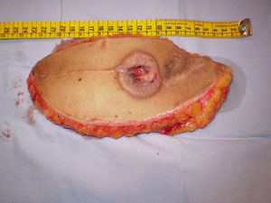 Exéresis amplia de metástasis de cáncer de cérvix en la piel.