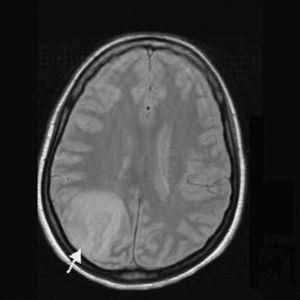 Resonancia magnética, corte transversal. Imagen de infarto cortical en parietal derecho. Ventrículo cerebral homolateral colapsado.