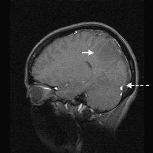 Angiorresonancia magnética, corte parasagital. Imagen de infarto cerebral (flecha continua). Detención en la circulación del contraste en el seno longitudinal superior (flecha discontinua).