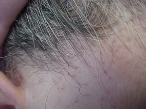Eritema perifolicular en zonas de alopecia cicatricial. Aspecto liquenoide.