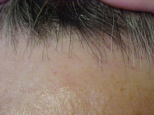 Retraso de la línea de implantación del cabello. Aspecto cicatricial.