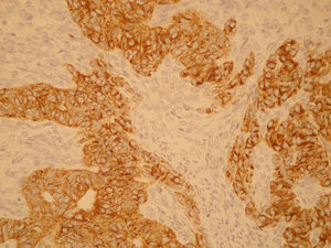 Microscópica (citoqueratinas AE1/AE3, 400×). Las citoqueratinas evidencian las células epiteliales.