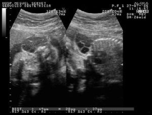 Masa quística multiseptada de 49×28×37mm en la región cervical fetal, indicativa de linfangioma quístico.