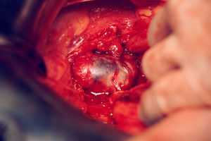 Laparotomía. Masa tumoral bien encapsulada que engloba al uréter izquierdo.