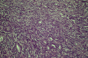 Microscópica (coloración de hematoxilina-eoxina, 40×). Carcinosarcoma.