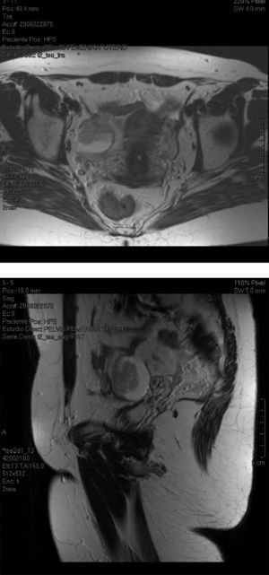 Resonancia magnética: lesión quística con porción solidovegetante, abigarrada, que crece hacia el interior de la lesión. Depende del ovario derecho y mide 4×4×3,5cm. Ganglios ilíacos visibles y no claramente aumentados de tamaño.
