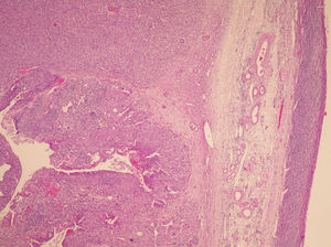 Tinción con hematoxilina y eosina ×40: tejido ovárico sustituido por un tumor que muestra patrón sólido y glandular y que rechaza el parénquima ovárico.