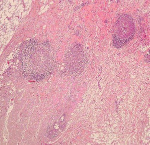Granulomas epitelioides necrosantes aislados. En la porción inferior se ve un lobulillo glandular mamario atrófico.