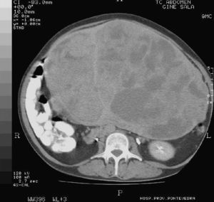 Tomografía computarizada abdominopélvica: gran tumoración heterogénea.