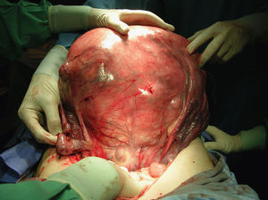 Gran tumoración uterina de 8.000g con superficie lisa rosada e intensa vascularización. Se observan ambos anejos macroscópicamente normales.