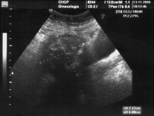 Ecografía vaginal, compatible con mioma uterino calcificado en el fundus.