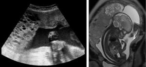 Ecografía y resonancia magnética que muestran la placentación anormal.