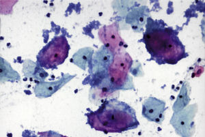 Citología (Papanicolaou, 40×). Vaginosis bacteriana.