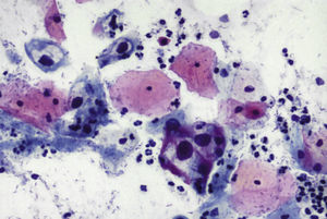 Citología (Papanicolaou, 40×). Coilocitos. Lesiones escamosas intraepiteliales de bajo grado.