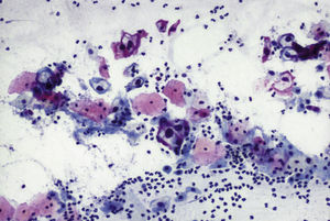 Citología (Papanicolaou, 10×). Coilocitos. La misma anterior para ver el fondo inflamatorio con leucocitos.