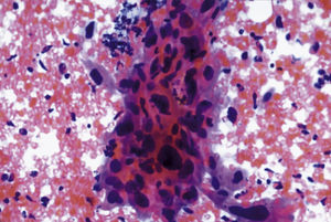 Citología (Papanicolaou, 40×). Carcinoma. Fondo de diátesis tumoral, hemorrágica.