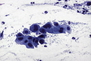 Citología (Papanicolaou, 40×). Lesiones escamosas intraepiteliales de alto grado.