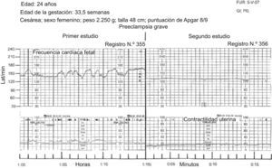En el primer registro la frecuencia cardíaca fetal tuvo un patrón reactivo, el segundo corresponde a un patrón no reactivo; a la paciente le practicaron cesárea.