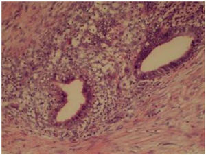 Estructuras glandulares correspondientes a las glándulas endometriales rodeadas de estroma endometrial.