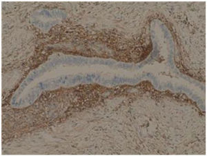 Estudio inmunohistoquímico con CD10 que tiñe de marrón el estroma endometrial.
