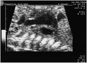 Estenosis e hiperrefringencia de la válvula pulmonar.