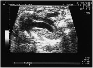 Estenosis e hiperrefringencia de la válvula pulmonar.