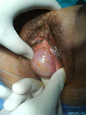 Exposición del mioma vaginal. Presenta a la inspección un aspecto semejante a un cistocele de tercer grado y aumenta con maniobras de Valsalva.