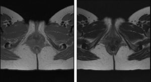 Resonancia magnética nuclear donde se aprecia la lesión infiltrante (linfoma). Imagen izquierda turbo spin echo (TSE) secuencia (T2). Imagen derecha short time inversion recovery (STIR).