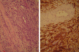 Anatomía patológica: linfoma difuso. En la imagen de la izquierda tinción hematoxilina-eosina (H/E) a un aumento 20×. La izquierda muestra positividad para CD20 (marcador B).