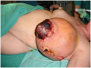 Paciente de 66 años con tumor phyllodes gigante de mama izquierda ulcerado.