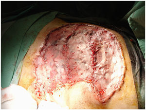 Reconstrucción mamaria inmediata mediante injerto cutáneo.