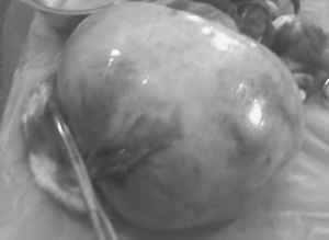 Vista macroscópica del tecoma ovárico.