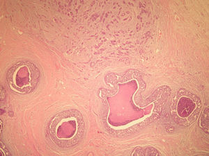 Anatomía patológica microscópica (hematoxilina eosina [HE], 40×). Componente infiltrante (arriba) e in situ tipo comedo (abajo).