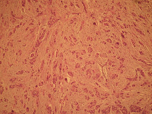 Anatomía patológica microscópica (HE, 100×). Grupos sólidos de células tumorales atípicas con mínima formación de glándulas.