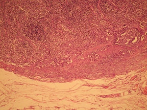 Anatomía patológica microscópica (HE, 100×). Metástasis en uno de los ganglios axilares, con invasión del seno subcapsular por células tumorales.