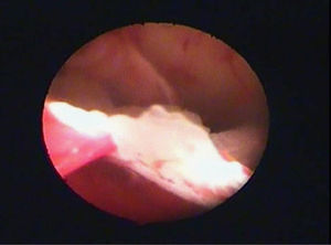 Imagen histerescoscópica. Placas óseas delgadas con bordes dentados de aspecto radiado, enclavadas en el endometrio sin integrarse en él.