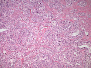 Componente epitelial maligno constituyendo áreas de adenocarcinoma (H-E×200).