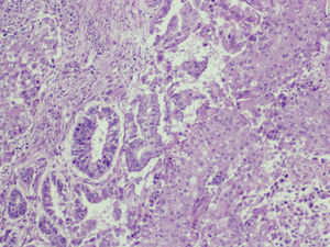 Anatomía patológica (HE ×100). Zona neoplásica epitelial con diferenciación adenomatosa, junto a áreas sólidas de apariencia escamosa.