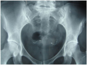 Colocación satisfactoria de los implantes tubáricos comprobada mediante radiografía pélvica.