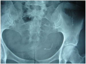 Radiografía pélvica que muestra uno de los implantes alojado en la cavidad abdominal.