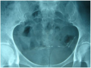 Radiografía pélvica tras la colocación de un nuevo implante en la paciente anterior.