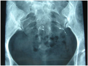 Tortuosidad aparente del sistema Essure® mediante radiografía pélvica.