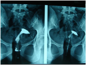 Correcta colocación de los microimplantes en la paciente anterior comprobada mediante histerosalpingografía.