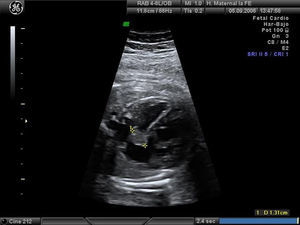 Rabdomioma en el septo interauricular. Corte de 4 cámaras; 34 semanas de gestación.