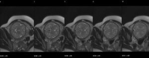 Resonancia magnética fetal con secuencias potenciadas en T2 a las 24 semanas de gestación. En la imagen se aprecian cortes seriados del cerebro fetal.