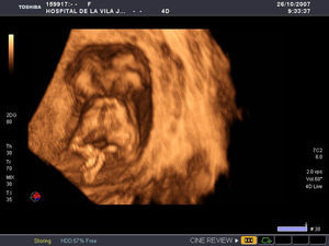 Imagen de ecografía 3D que muestra ambos fetos unidos por el tórax y la parte superior del abdomen. Existe separación total de las cabezas, situadas cara a cara, y se visualizan las columnas vertebrales y las cuatro extremidades en ambos fetos.