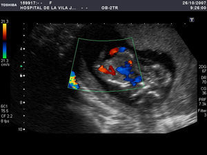 Mediante Doppler color se identificó un corazón único, la aorta en cada uno de los fetos y una única arteria renal en cada gemelo.